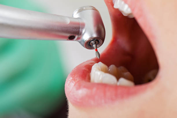 Best Dental Abscess Treatment in Spring Lake, NC